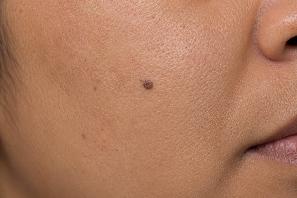 Lesions