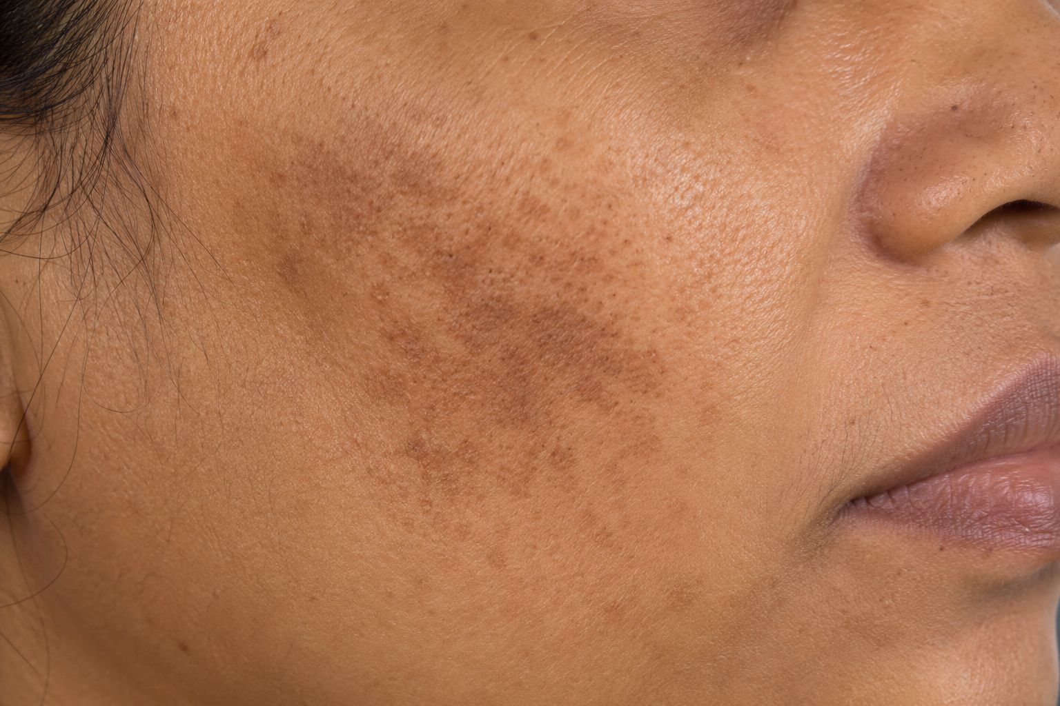 Pigmentation